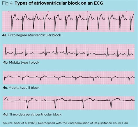 abnormal ekg readings|list of all ekg rhythms.